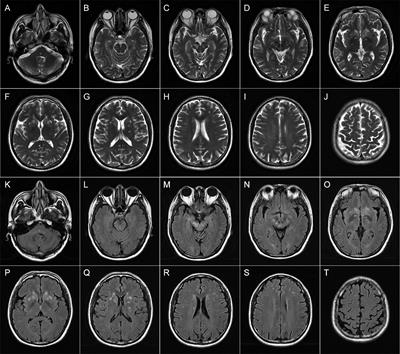 Case Report: Prominent Brainstem Involvement in Two Patients With Anti-CASPR2 Antibody-Associated Autoimmune Encephalitis